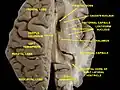Vue supérieure d'une coupe horizontale d'une dissection profonde des ventricules du cerveau et des ganglions de la base.