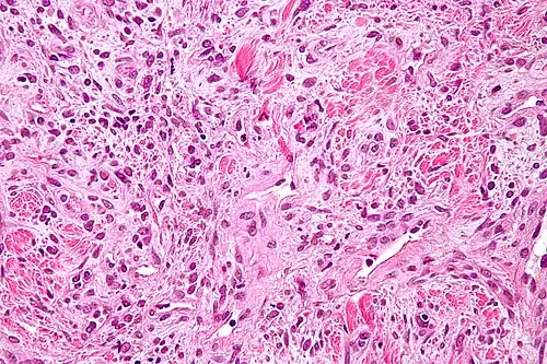 Champ de cellules roses aux noyaux pourpres, séparées de plages de collagène fuchsia.