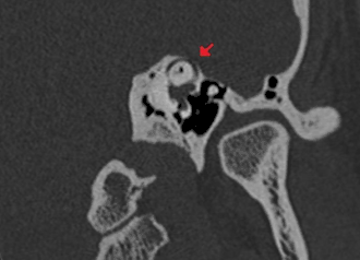 Description de l'image Superior semicircular canal dehiscence syndrome - CT scan.gif.