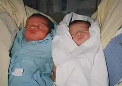 Jumelles identiques nées souffrant du syndrome transfuseur-transfusé.