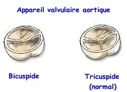 Description de l'image valves-aortiques.jpg.