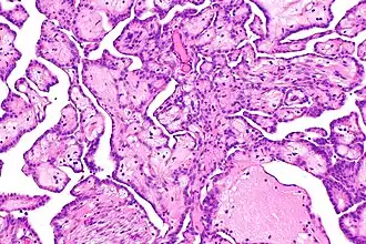 cellules de mésothéliome.