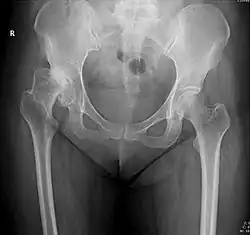 radiographie de face du bassin d'un homme adulte montrant à droite un déplacement vers le haut de la tête du fémur qui est très déforme mais n'a pas totalement perdu le contact avec le cotyle