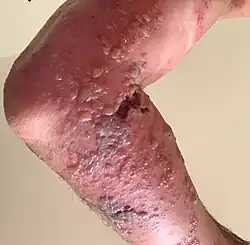 Zona extensif chez un immunodéprimé