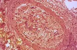 Hyphes dans un vaisseau sanguin (vue en coupe).