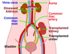 Description de l'image kidtransplant.svg.