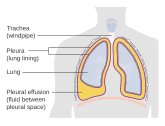 Description de l'image Diagram showing a build up of fluid in the lining of the lungs (pleural effusion) CRUK 054.svg.